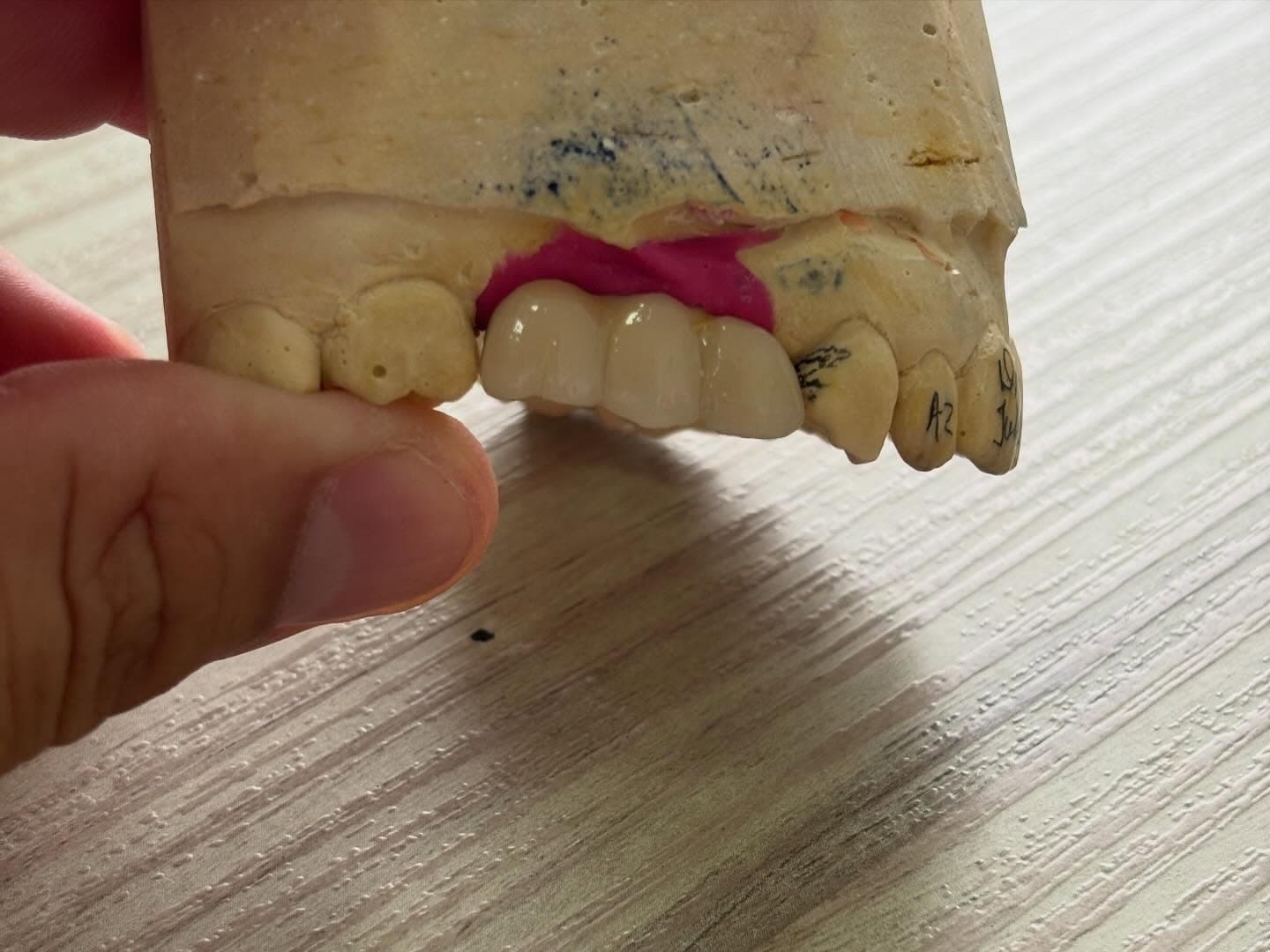 Modelo de dentes mostrando restauração odontológica.